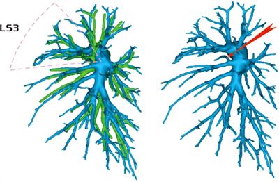 Anatomical variation analysis of left upper pulmonary blood vessels and bronchi based on three-dimensional reconstruction of chest CT